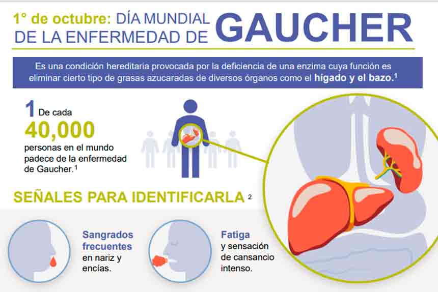 Cinco señales que alertan sobre la enfermedad de Gaucher